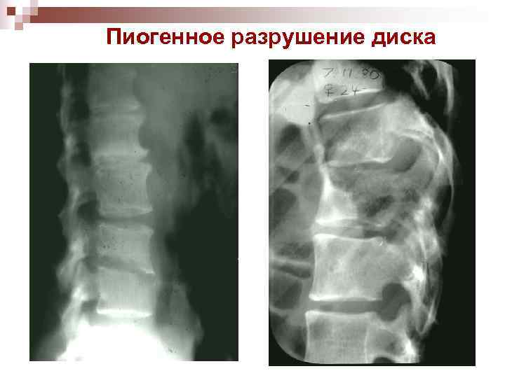 Пиогенное разрушение диска 