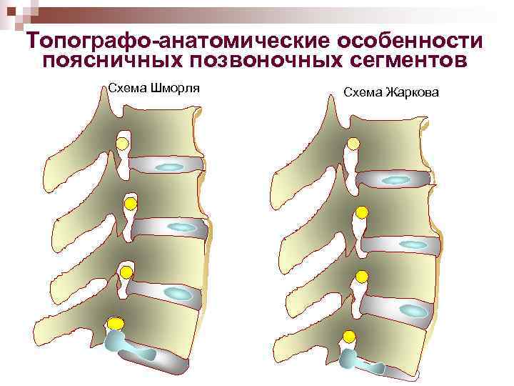 Топографо-анатомические особенности поясничных позвоночных сегментов Схема Шморля Схема Жаркова 