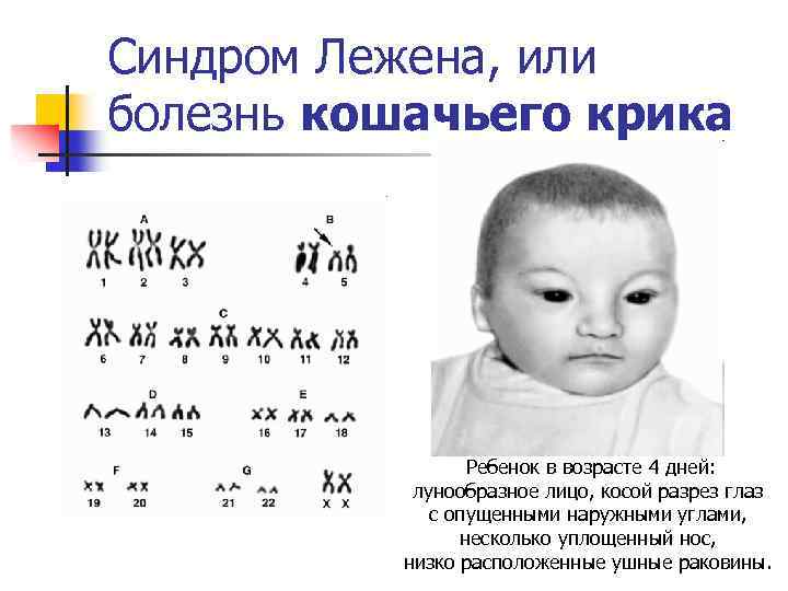 Синдром Лежена, или болезнь кошачьего крика Ребенок в возрасте 4 дней: лунообразное лицо, косой