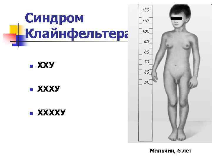 Синдром Клайнфельтера n ХХУ n ХХХХУ Мальчик, 6 лет 