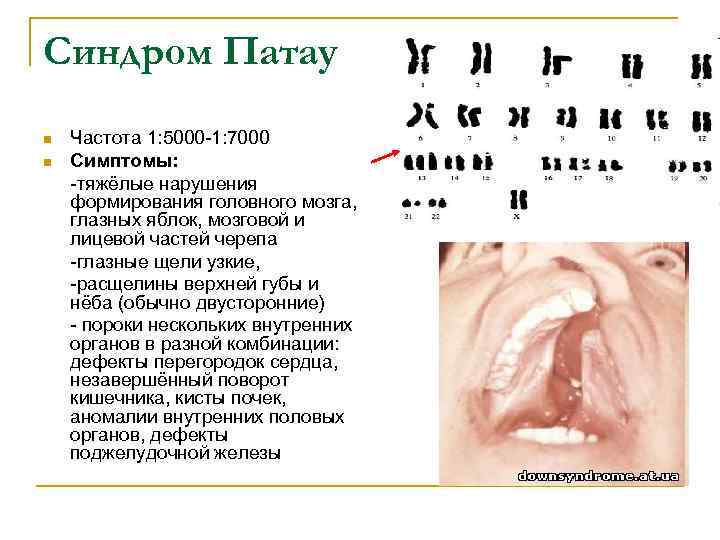Синдром Патау n n Частота 1: 5000 -1: 7000 Симптомы: -тяжёлые нарушения формирования головного