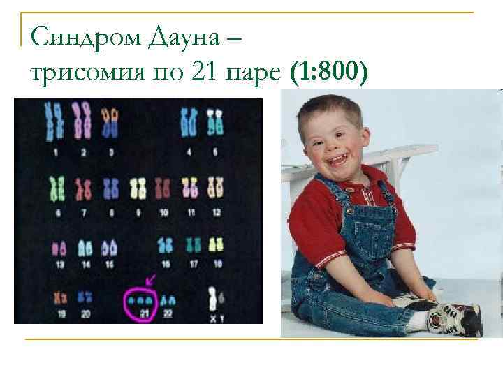 Синдром Дауна Тип наследования. Синдром Дауна наследование. Фенотипическая карта генетика. Карта фенотипа. Фенотип ребенка с синдромом дауна