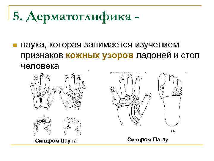 5. Дерматоглифика n наука, которая занимается изучением признаков кожных узоров ладоней и стоп человека
