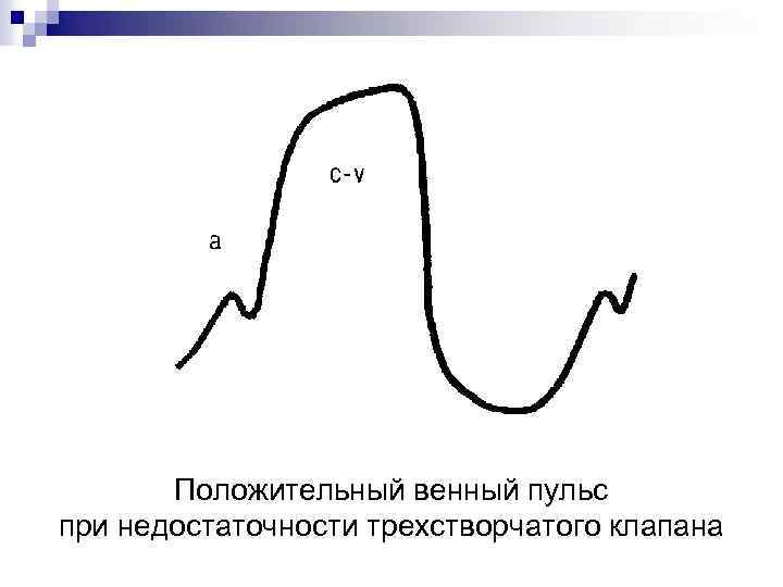 Положительный венный. Венный пульс методы исследования. Положительный венный пульс. Положительный и отрицательный венный пульс. Отрицательный венозный пульс.