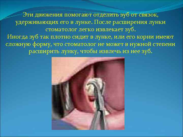 Эти движения помогают отделить зуб от связок, удерживающих его в лунке. После расширения лунки