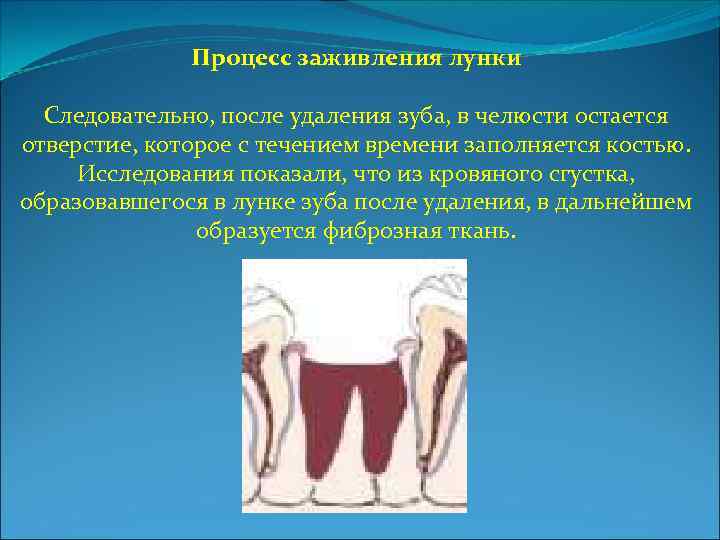 Процесс заживления лунки Следовательно, после удаления зуба, в челюсти остается отверстие, которое с течением