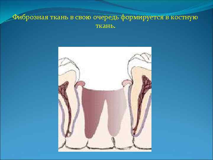 Фиброзная ткань в свою очередь формируется в костную ткань. 