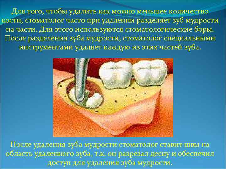 Удалить кости. Распиливанием кости при удалении зуба мудрости. Деление зуба на две части. Удаление зуба мудрости в кости. Как пилят кость при удалении зуба.