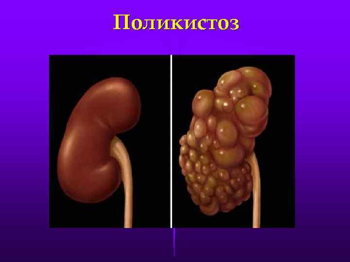 Поликистоз 