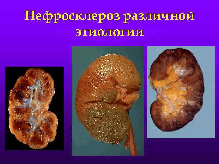 Нефросклероз различной этиологии 