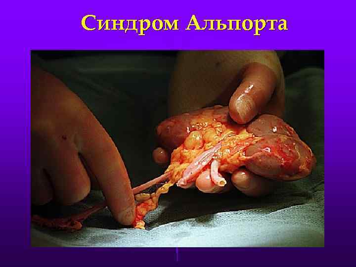 Синдром Альпорта 