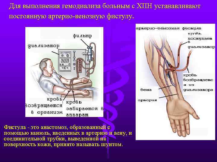 Формирование фистулы