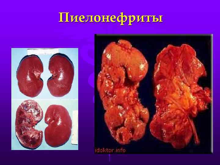 Пиелонефриты норма 