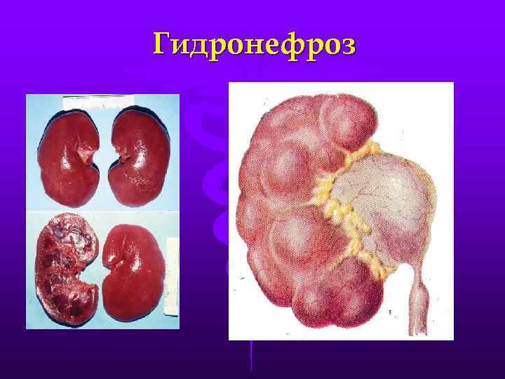 Гидронефроз 