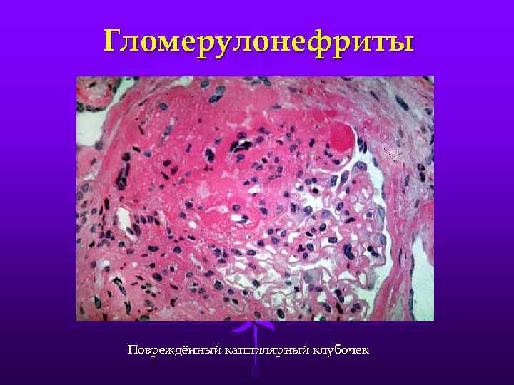 Гломерулонефриты Повреждённый каппилярный клубочек 