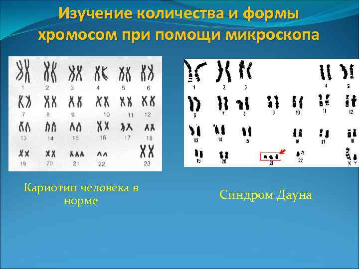 Изучение количества и формы хромосом при помощи микроскопа Кариотип человека в норме Синдром Дауна