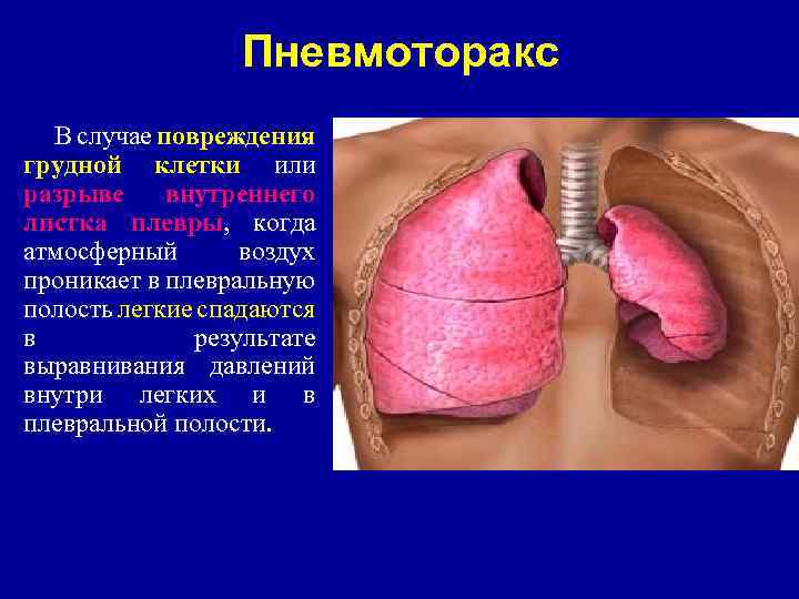 Пневмоторакс В случае повреждения грудной клетки или разрыве внутреннего листка плевры, когда атмосферный воздух