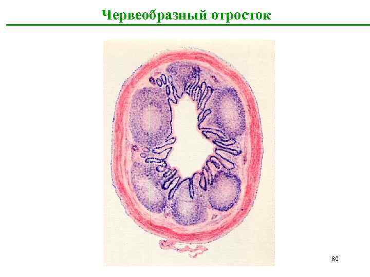 Червеобразный отросток 80 