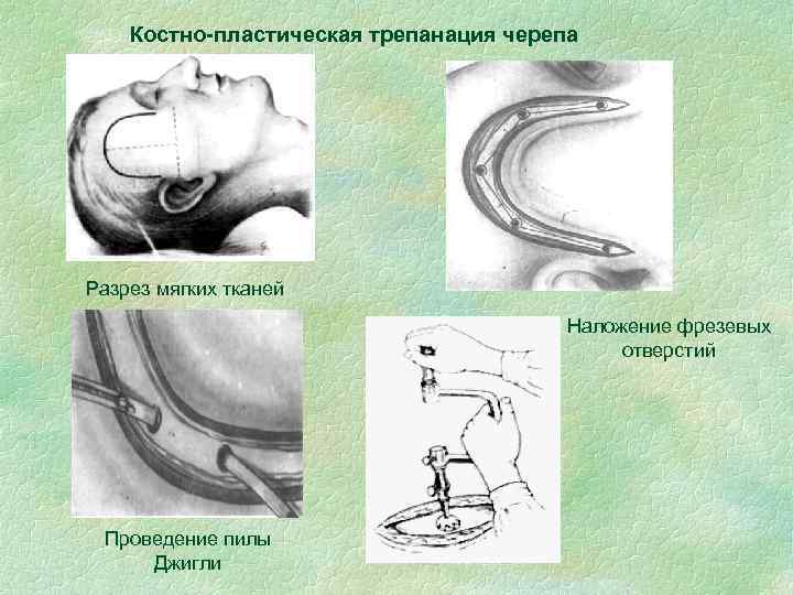 Костно-пластическая трепанация черепа Разрез мягких тканей Наложение фрезевых отверстий Проведение пилы Джигли 