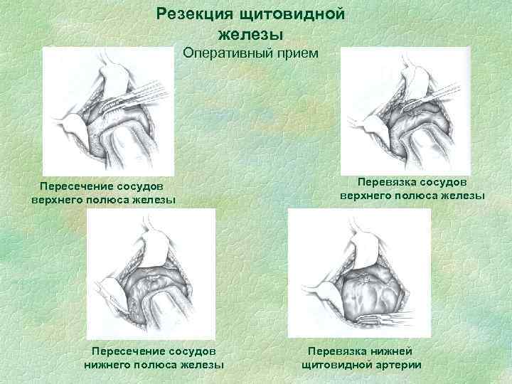Резекция щитовидной железы Оперативный прием Пересечение сосудов верхнего полюса железы Пересечение сосудов нижнего полюса