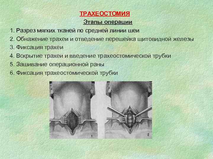 ТРАХЕОСТОМИЯ Этапы операции 1. Разрез мягких тканей по средней линии шеи 2. Обнажение трахеи