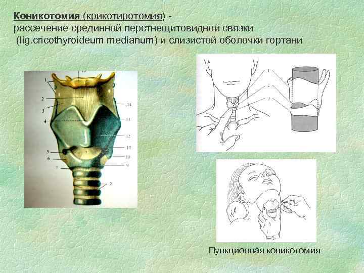 Коникотомия (крикотиротомия) рассечение срединной перстнещитовидной связки (lig. cricothyroideum medianum) и слизистой оболочки гортани Пункционная