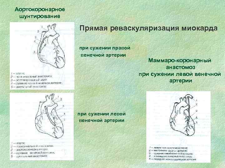 Аортокоронарное шунтирование Прямая реваскуляризация миокарда при сужении правой венечной артерии при сужении левой венечной