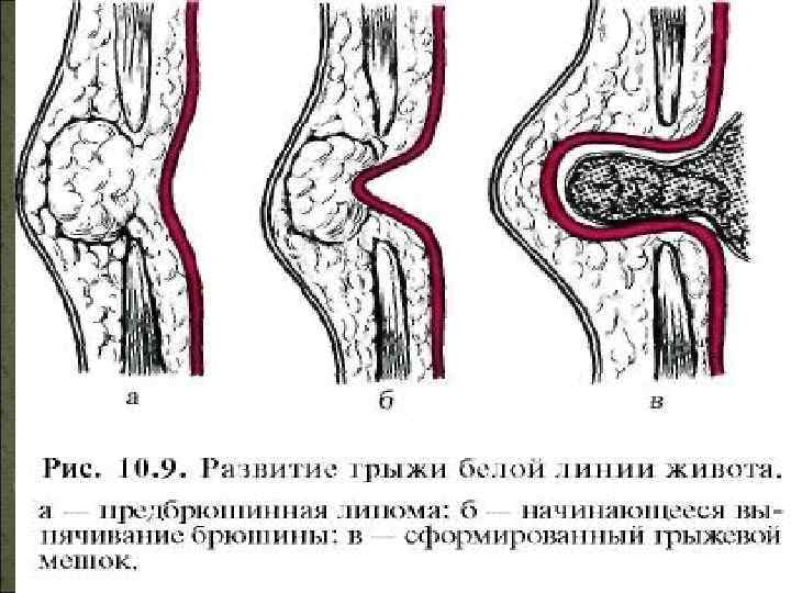 Грыжа белой линии живота на узи фото