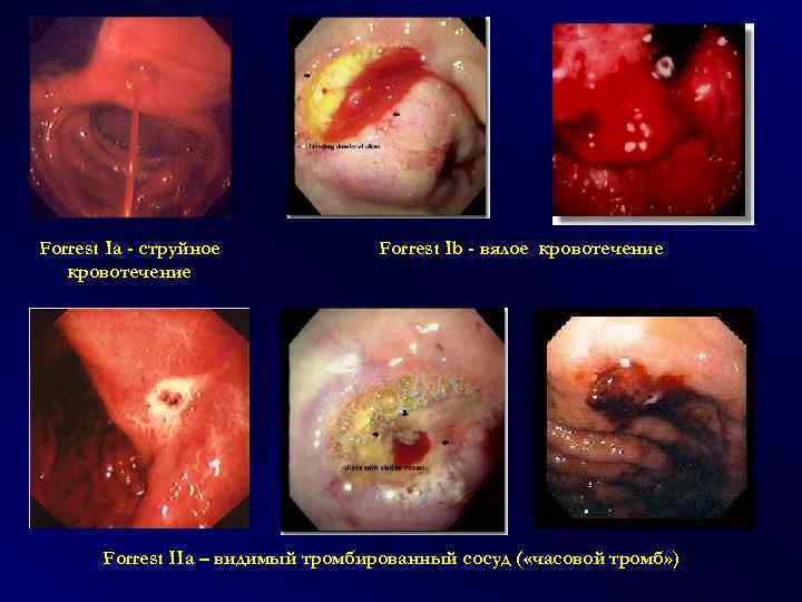 Forrest Ia - струйное кровотечение Forrest Ib - вялое кровотечение Forrest IIa – видимый