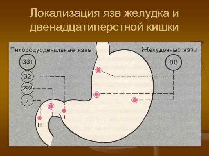 Локализация язв желудка и двенадцатиперстной кишки 