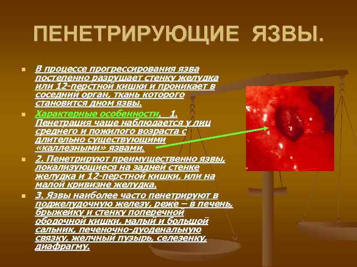 ПЕНЕТРИРУЮЩИЕ ЯЗВЫ. В процессе прогрессирования язва постепенно разрушает стенку желудка или 12 -перстной кишки