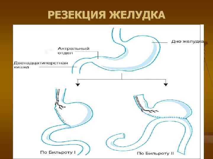 РЕЗЕКЦИЯ ЖЕЛУДКА 