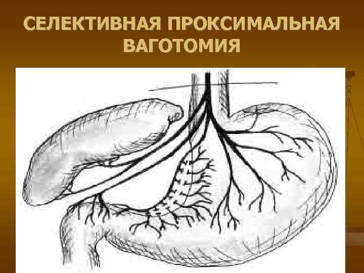 Осложнения язвенной болезни презентация факультетская хирургия