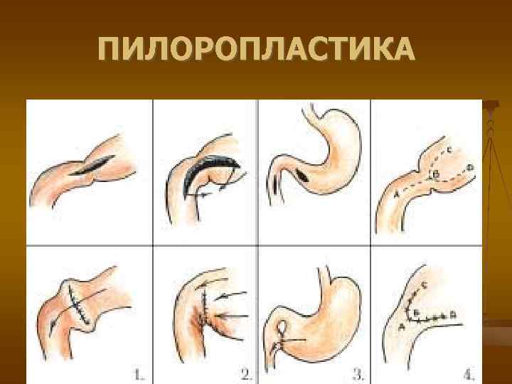 ПИЛОРОПЛАСТИКА 