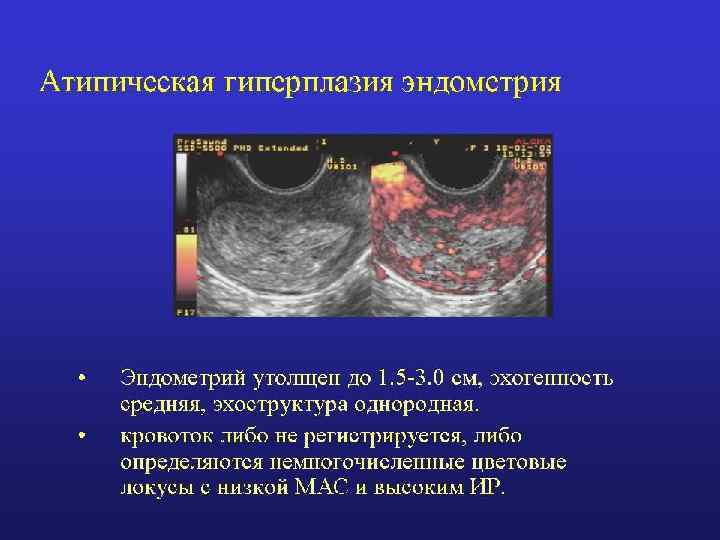 Причины эндометрии у женщин. Атипическая гиперплазия эндометрия терапия. Атипическая гиперплазия эндометрия УЗИ. Эхография гиперплазии эндометрия. Гиперплазия эндометрия на УЗИ.