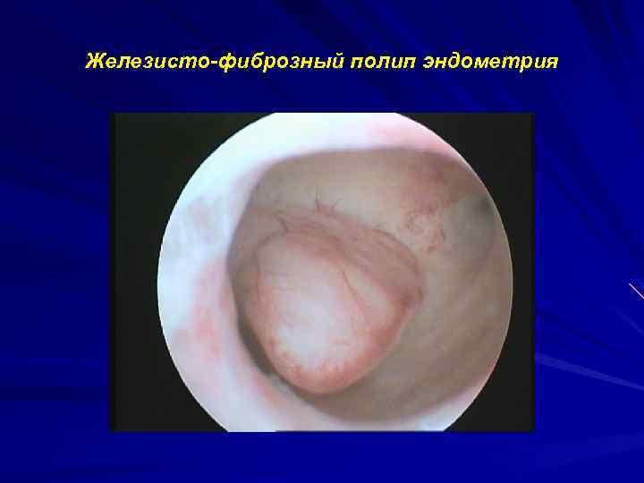Железисто фиброзный полип эндометрия 