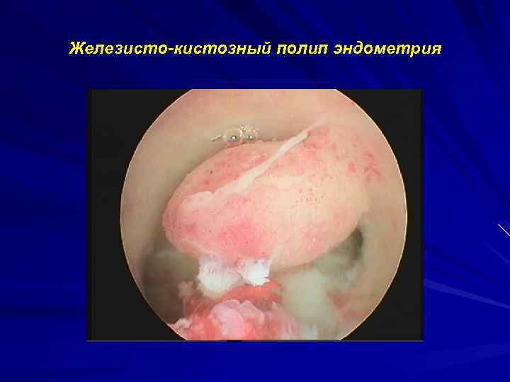 Железисто кистозный полип эндометрия 