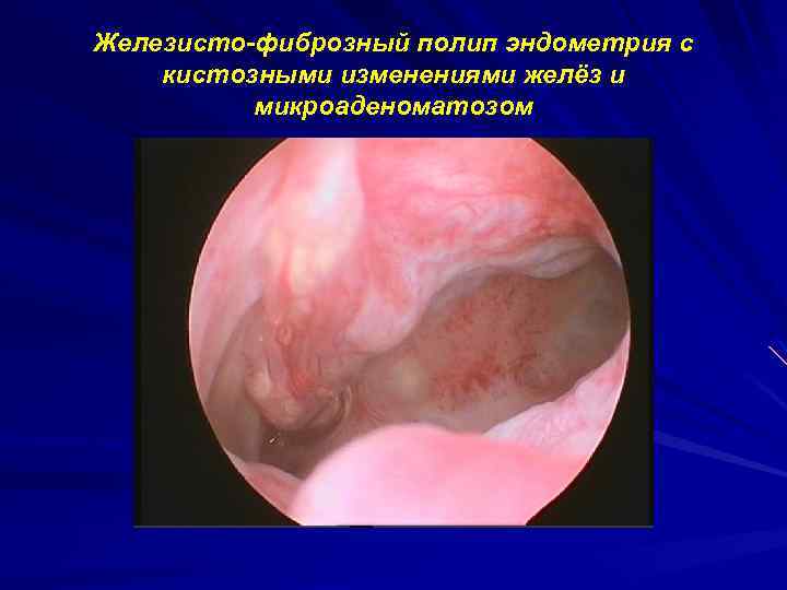 Железисто фиброзный полип эндометрия с кистозными изменениями желёз и микроаденоматозом 