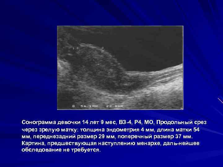 Сонограмма девочки 14 лет 9 мес, ВЗ 4, Р 4, МО, Продольный срез через
