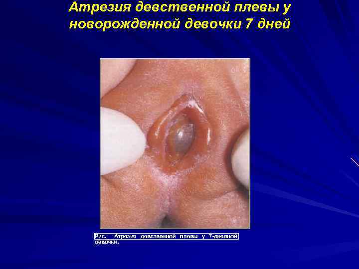Атрезия девственной плевы у новорожденной девочки 7 дней Рис. Атрезия девственной плевы у 7