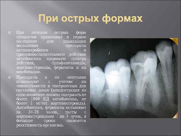 Острый очаговый пульпит презентация