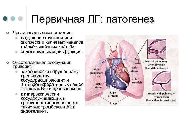 Первичная ЛГ: патогенез ¢ Чрезмерная вазоконстрикция: l l ¢ нарушение функции или экспрессии калиевых