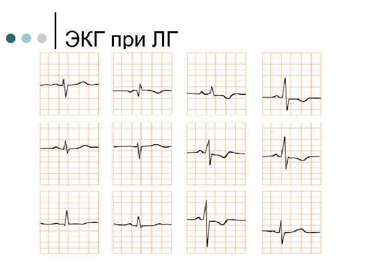 ЭКГ при ЛГ 