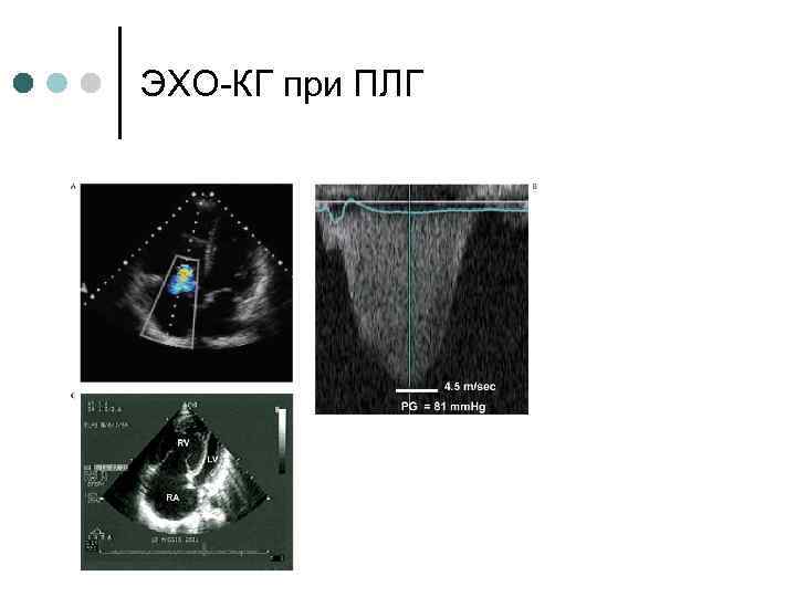 ЭХО-КГ при ПЛГ 