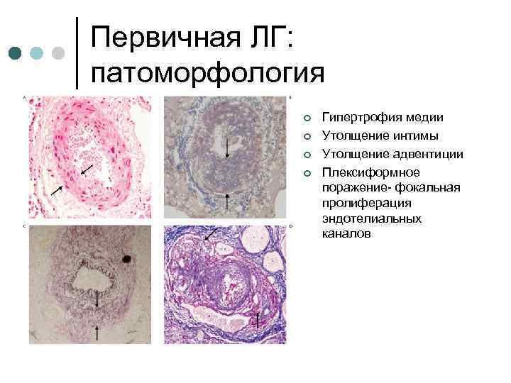 Первичная ЛГ: патоморфология ¢ ¢ Гипертрофия медии Утолщение интимы Утолщение адвентиции Плексиформное поражение- фокальная