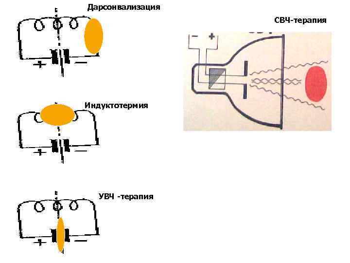 Дарсонвализация СВЧ-терапия Индуктотермия УВЧ -терапия 