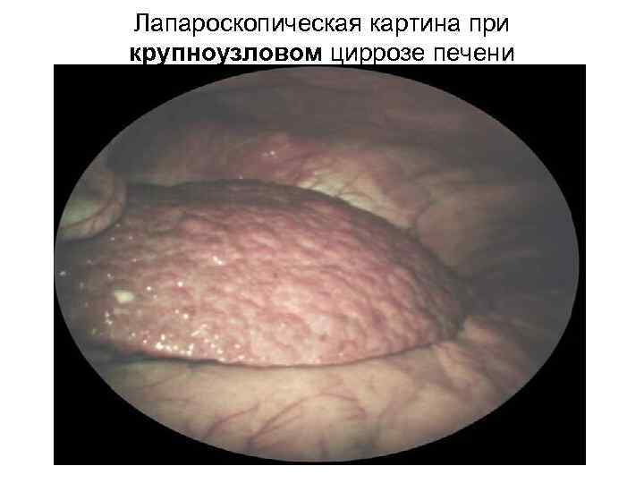 Лапароскопическая картина при крупноузловом циррозе печени 