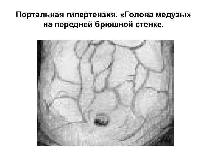 Портальная гипертензия. «Голова медузы» на передней брюшной стенке. 