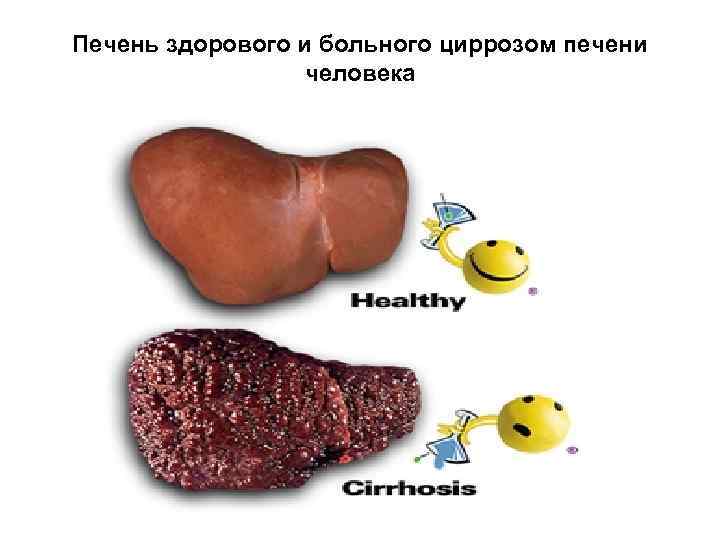 Печень здорового и больного циррозом печени человека 