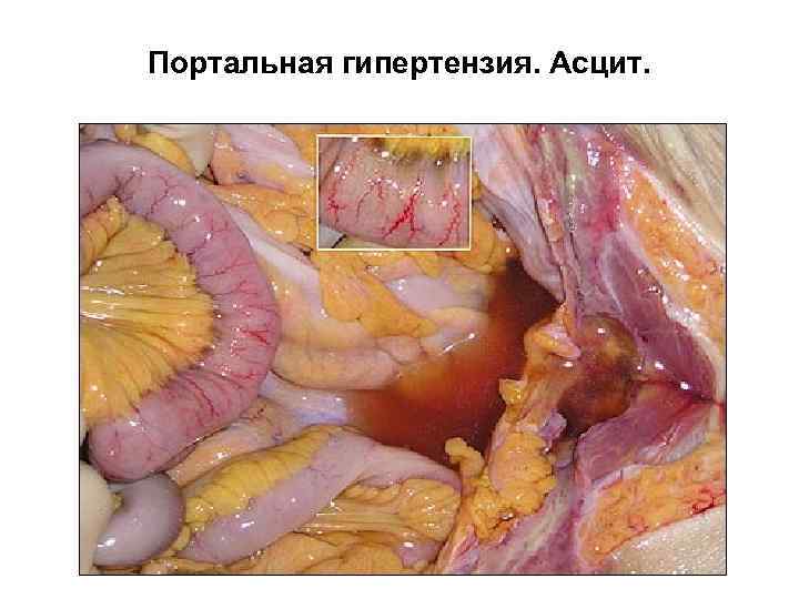 Портальная гипертензия. Асцит. 